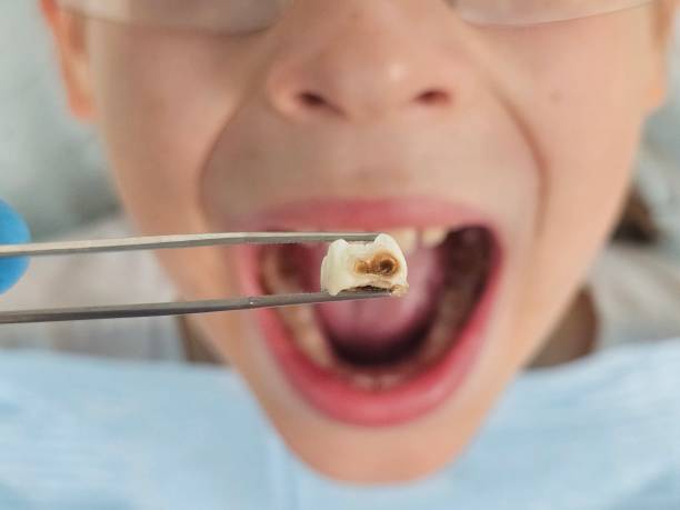 Best Chipped Tooth Repair Near Me  in North Zanesville, OH